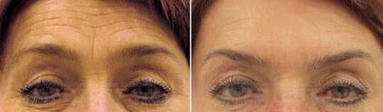 Подмладяване на полето на челото