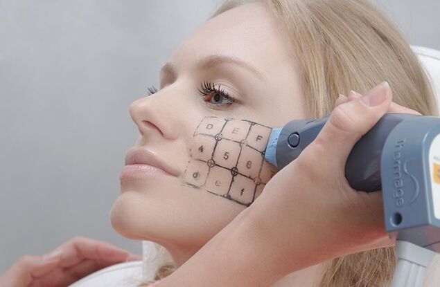 Процедура термаж